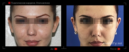 Отопластика 24 фото до и после процедуры