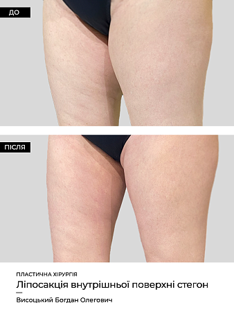 Лазерный липолиз бедер фото до и после процедуры