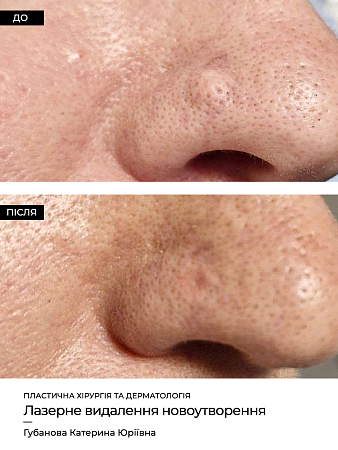 Удаление родинок 79 фото до и после процедуры