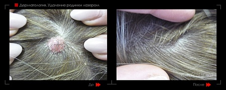 Удаление родинок17 фото до и после процедуры
