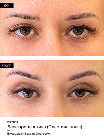 Блефаропластика 18 фото до и после процедуры
