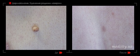 Удаление родинок 127 фото до и после процедуры