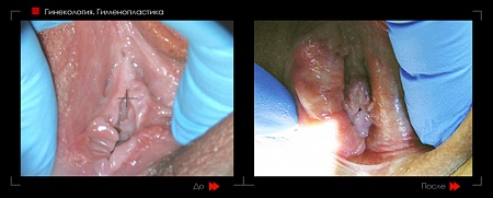 Гименопластика фото до и после процедуры