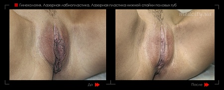 Лабиопластика 35 фото до и после процедуры
