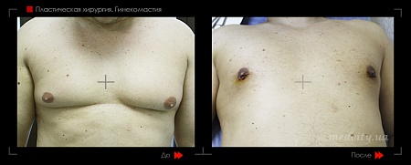 Гинекомастия 26 фото до и после процедуры