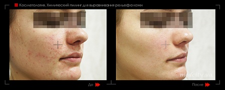 Химический пилинг 2 фото до и после процедуры