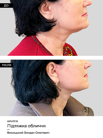 Подтяжка лица 3 фото до и после процедуры