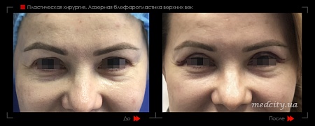 Блефаропластика 33 фото до и после процедуры