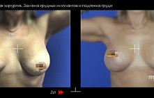 Подтяжка груди с имплантами