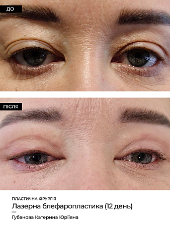 Блефаропластика  фото до и после процедуры