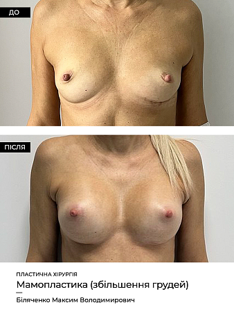 Маммопластика фото до и после процедуры