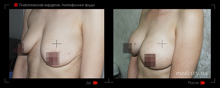 Липофилинг груди 7 фото до и после процедуры