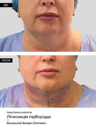 Lipoliz Lica 3 фото до и после процедуры