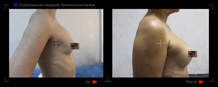 Замена грудных имплантов4 фото до и после процедуры