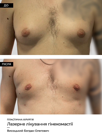 Гинекомастия фото до и после процедуры