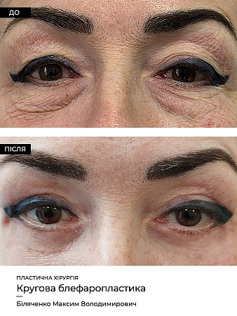 Блефаропластика нижних век фото до и после процедуры