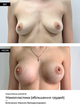 Маммопластика 7 фото до и после процедуры