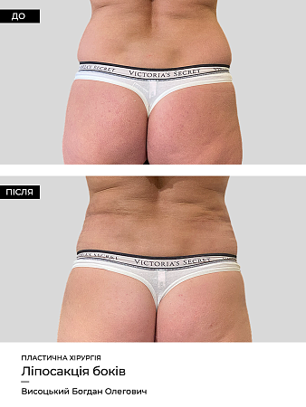 Лазерный липолиз тела 7 фото до и после процедуры