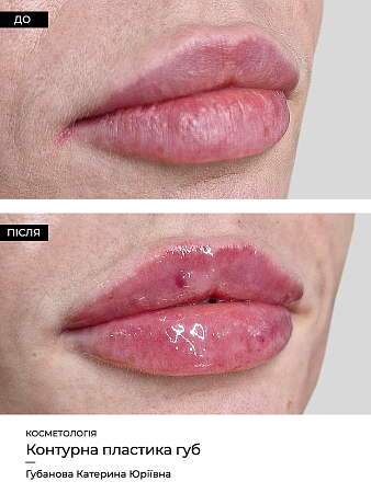 Увеличение губ 70 фото до и после процедуры
