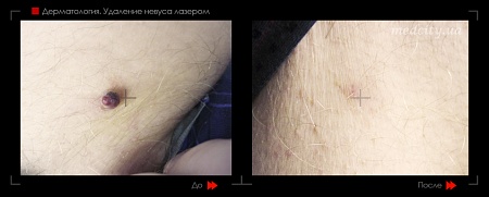 Лазерное удаление невуса 5 фото до и после процедуры