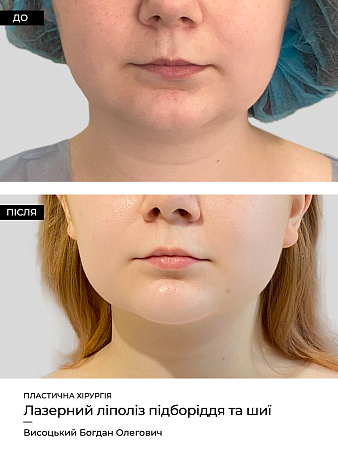 Lipoliz Lica 2 фото до и после процедуры