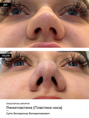Ринопластика 24 фото до и после процедуры
