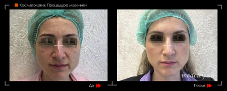 Тредлифтинг 3D мезонитями фото до и после процедуры