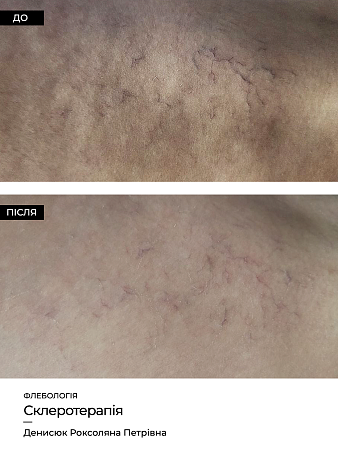 Склеротерапия 10 фото до и после процедуры