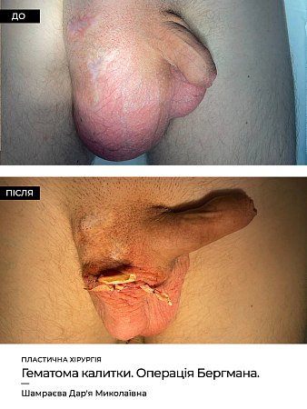 Лазерное удаление кондилом (урол.)-4 фото до и после процедуры