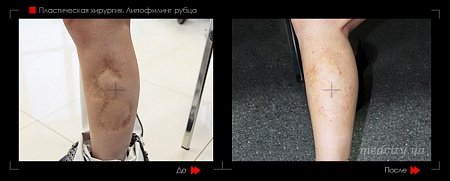 Липофилинг тела (рубца) фото до и после процедуры