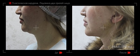Подтяжка лица 4 фото до и после процедуры
