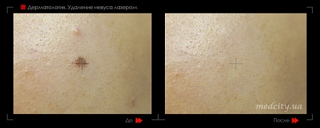 Лазерное удаление невуса 10 фото до и после процедуры