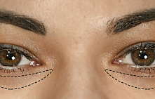 Лазерная блефаропластика нижних век