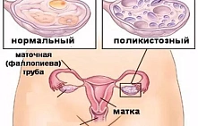 Как лечится поликистоз яичников?