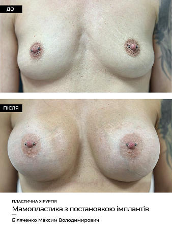 Маммопластика 23 фото до и после процедуры