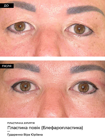 Blefaroplastika 6 фото до и после процедуры