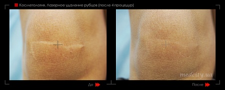 Шлифовка рубца 11 фото до и после процедуры