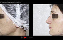 Нос с горбинкой. Когда нужна пластика?