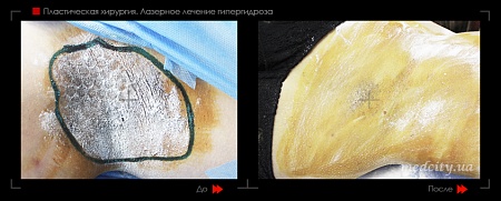 Лазерное лечение гипергидроза 3 фото до и после процедуры