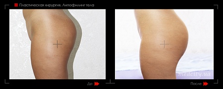 Липофилинг тела 6 фото до и после процедуры