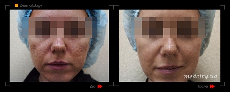 Lazernaya shlifovka фото до и после процедуры