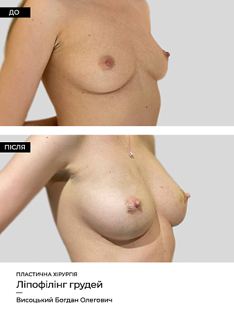 Маммопластика 29 фото до и после процедуры