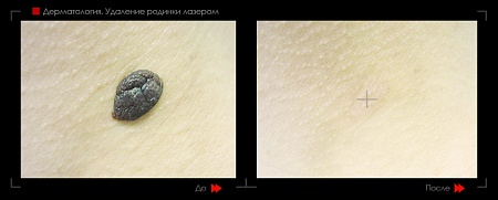 Удаление родинок 42 фото до и после процедуры