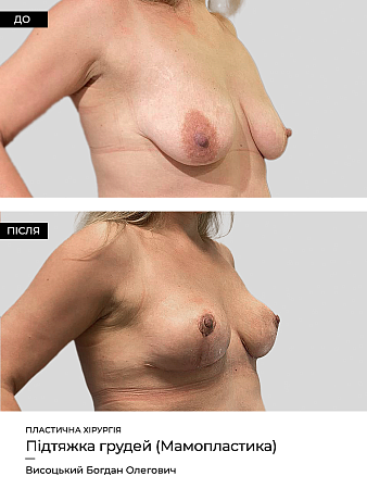 Мастопексия 3 фото до и после процедуры