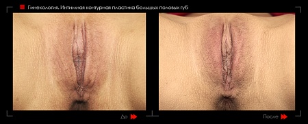 Контурная пластика половых губ 2 фото до и после процедуры