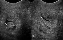 Полип цервикального канала