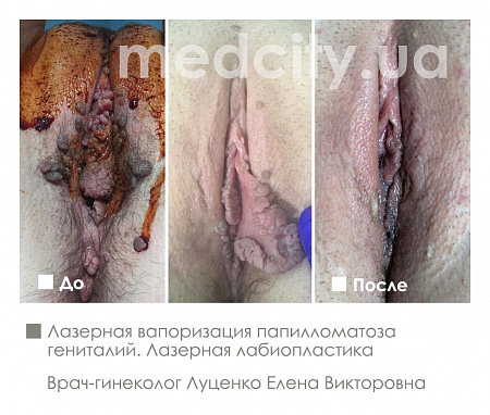 Лазерная вапоризация папилломатоза гениталий   фото до и после процедуры