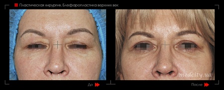 Блефаропластика 25 фото до и после процедуры