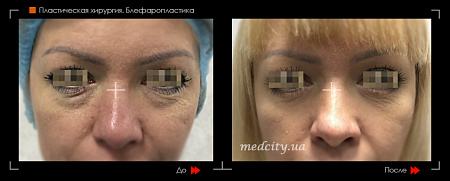 Блефаропластика нижних век фото до и после процедуры