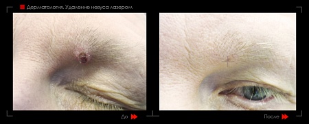 Лазерное удаление невуса 6 фото до и после процедуры